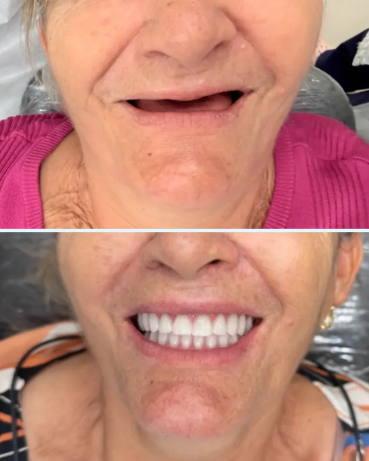 Caso 1: antes e depois de reabilitação com dentes fixos