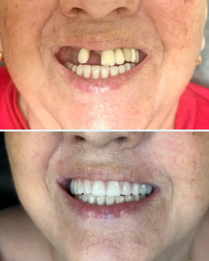 Caso 2: antes e depois de reabilitação com dentes fixos