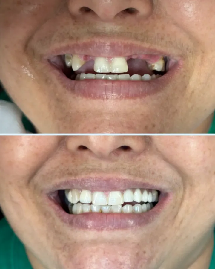 Caso 3: antes e depois de reabilitação com dentes fixos