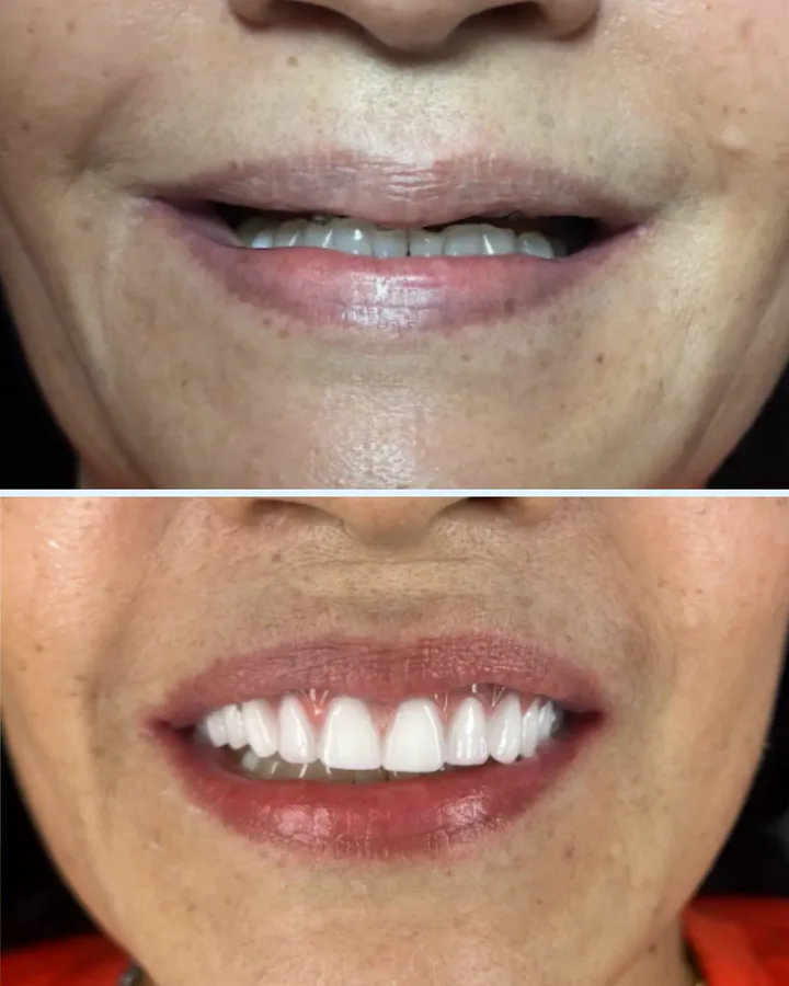 Caso 4: antes e depois de reabilitação com dentes fixos