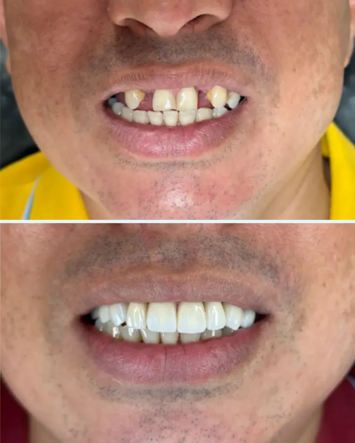 Caso 5: antes e depois de reabilitação com dentes fixos