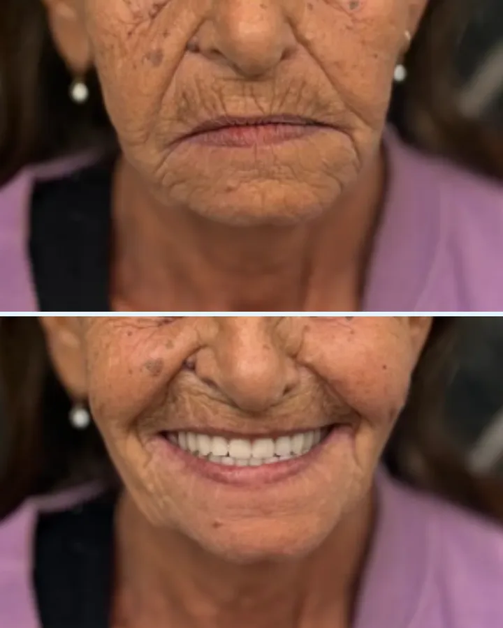 Caso 6: antes e depois de reabilitação com dentes fixos