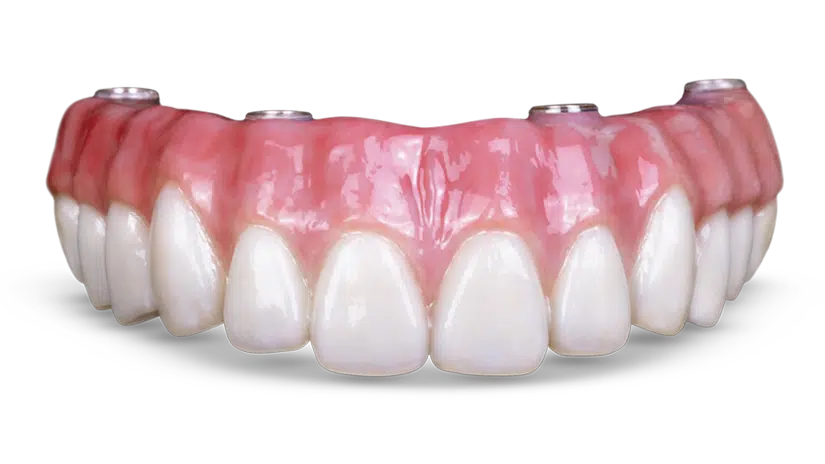 Prótese de dentes fixos, parafusada sobre implantes